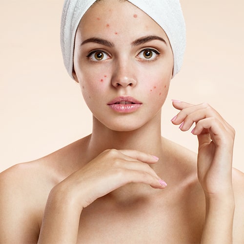 Acne/Pimples Management