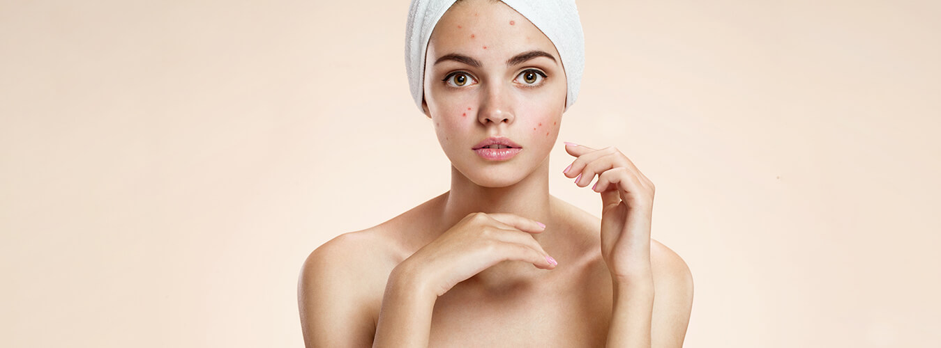 Acne/Pimples Management