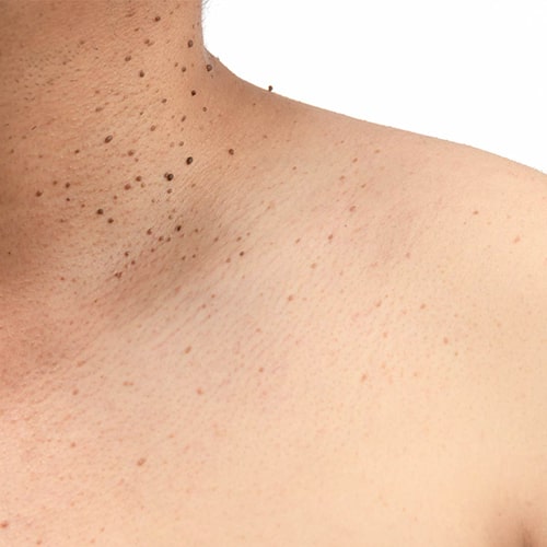 All forms of Skin Tag removal