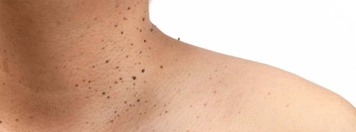 All Forms Of Skin Tag Removal