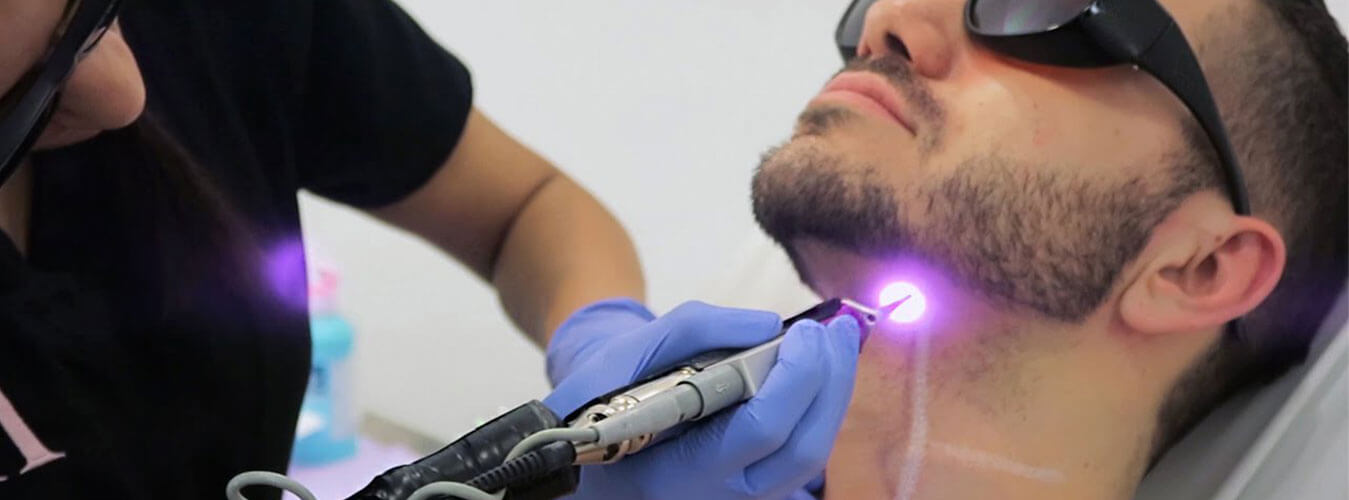 Laser for Beard Shaping
