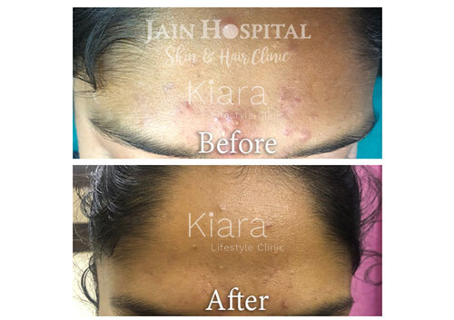 ACNE Treatment at Kiara Clinic in Delhi