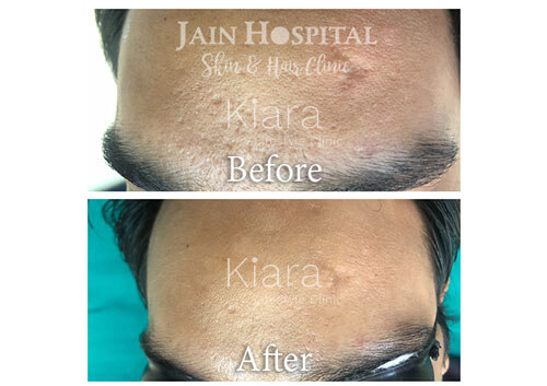 Acne Treatment in Kiara Clinic