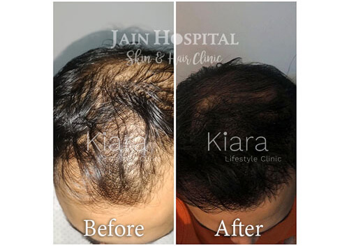 Hair Treatment in Kiara Lifestyle