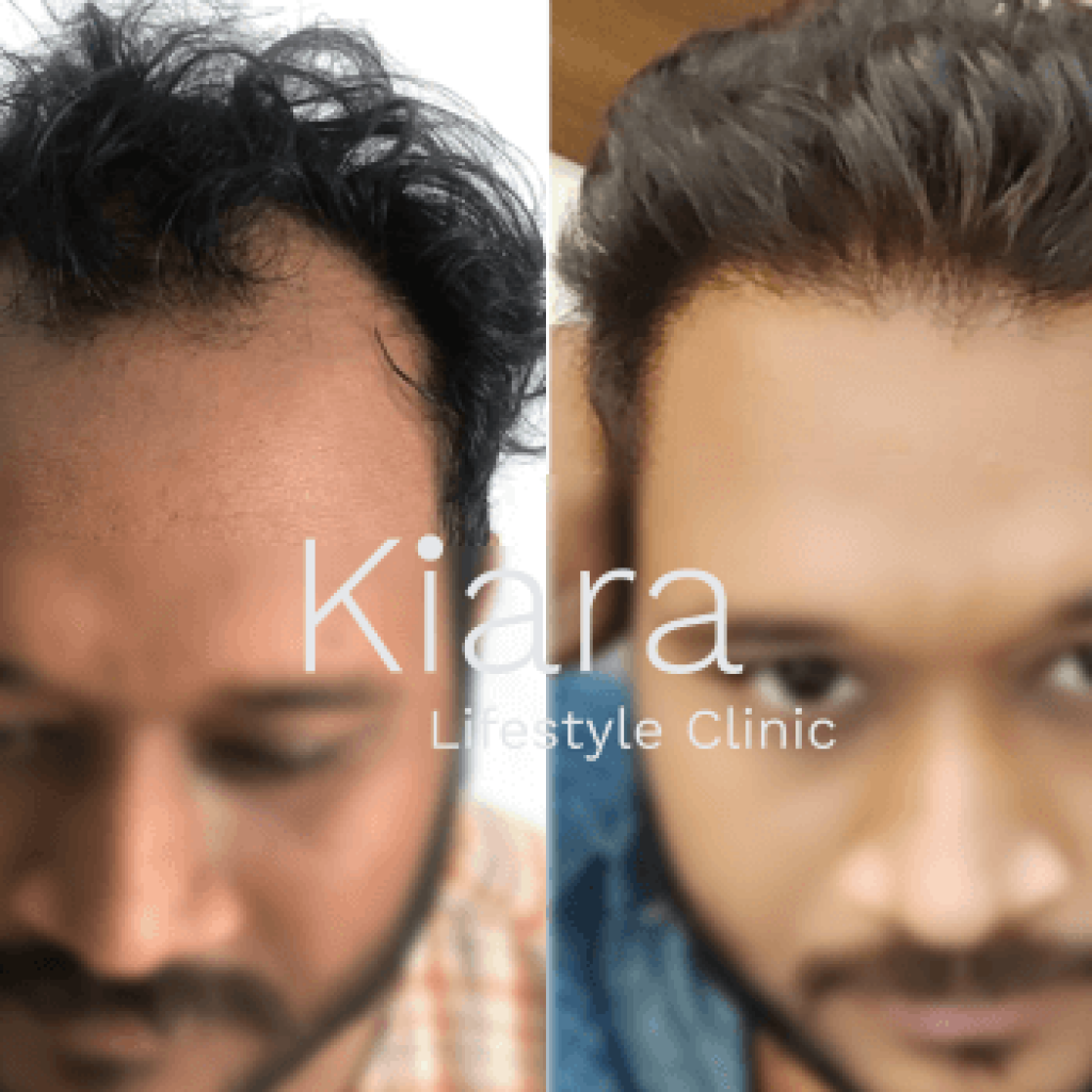 Revision Hair Transplant Surgery in Delhi | Kiara Lifestyle Clinic