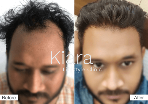 hair transplant by kiara clinic in Delhi NCR
