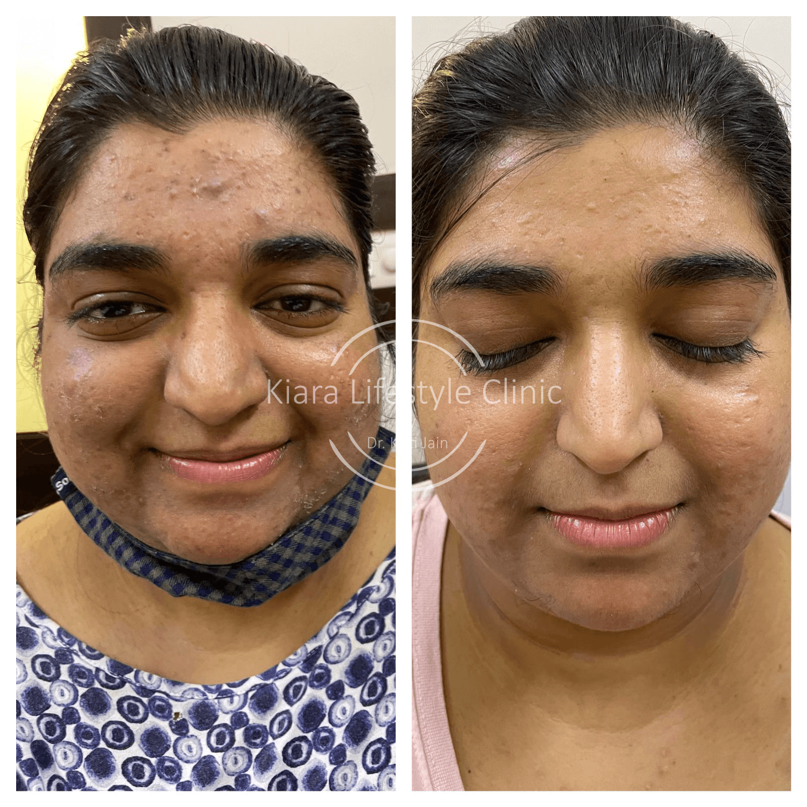 Acne Treatment Treated at Kiara Clinic in East Delhi by Dr. Kriti Jain