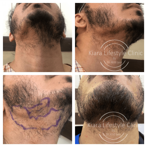 Beard Transplant at Kiara Clinic in East Delhi