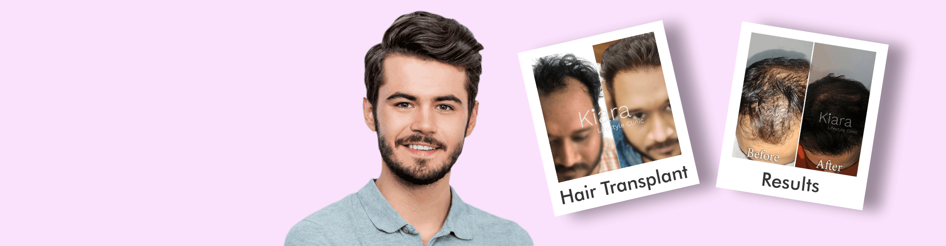 before and after hair transplant by dr kriti jain at kiara clinic in east delhi banner