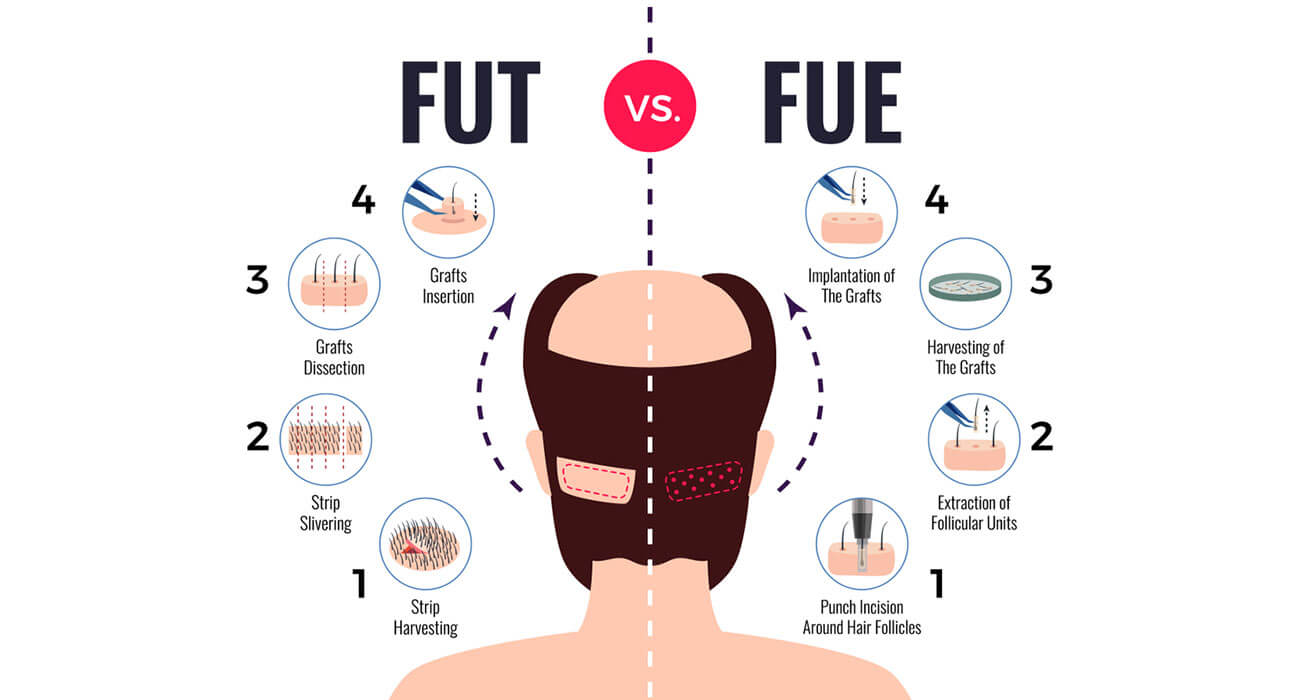 FUE Vs FUT, Know all about Hair transplant