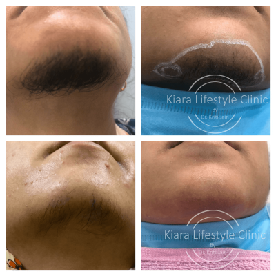 Laser Hair Reduction before and after at Kiara Clinic in East Delhi by Dr. Kriti Jain