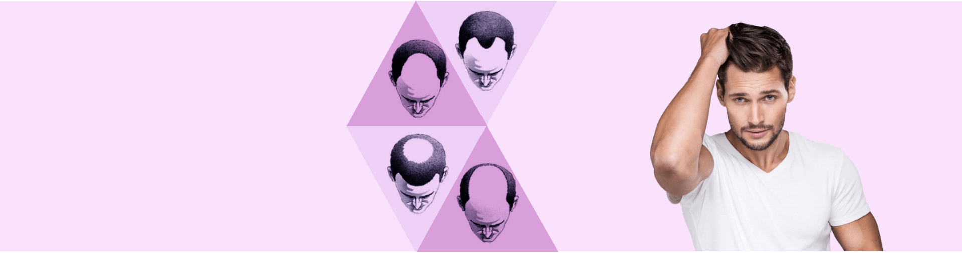 types of baldness at kiara clinic in east delhi banner