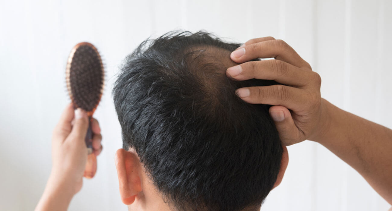 Hair fall after fever: Types of Hair loss. Book appointment at Kiara Clinic
