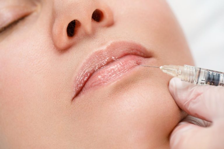 Lip augmentation