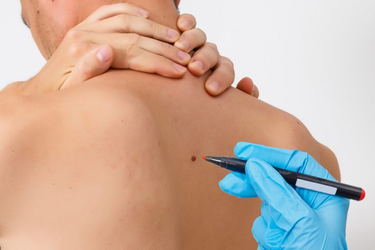 How To Remove a Mole Without a Surgery: 13 Steps