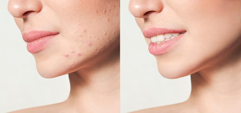 Is Scar Correction Possible?