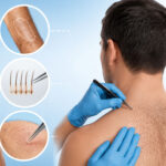A Vital Guide To Body Hair Transplant: Everything You Need To Know