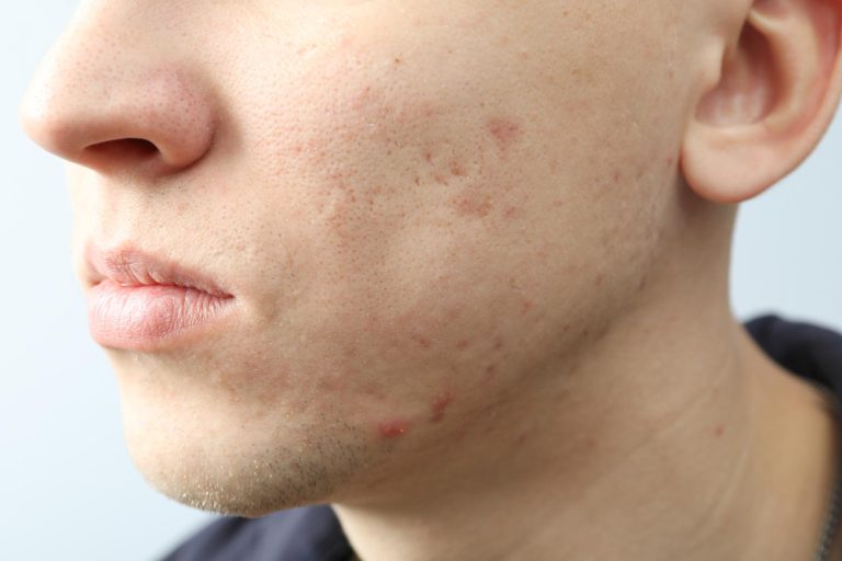 Scar Removal: What You Need to Know