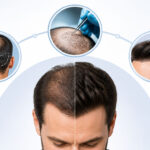 5 Reasons To Get A Revision Hair Transplant