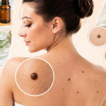 25 Ways to Get Rid of Moles on Your Skin