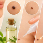 How To Remove a Mole Without a Surgery: 13 Steps