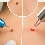 4 Ways to Remove Moles Without Surgery