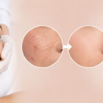 Guide To Getting Rid of Acne Scars by Microdermabrasion