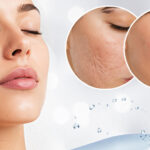 How to Use Microdermabrasion to Melt Your Wrinkles