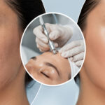 Microdermabrasion Before And After A Comprehensive Guide To The Treatment