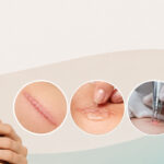 Scar Removal: What You Need to Know