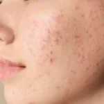 Skin Care: 3 Effective Ways To Get Rid Of Acne