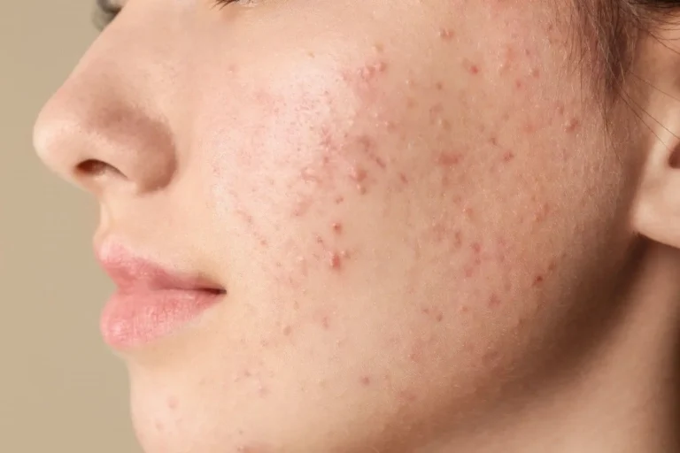 Skin Care: 3 Effective Ways To Get Rid Of Acne