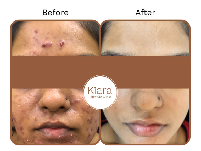 acne treatment result