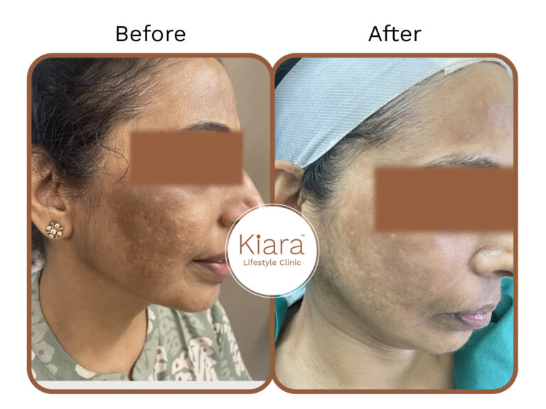melasma result