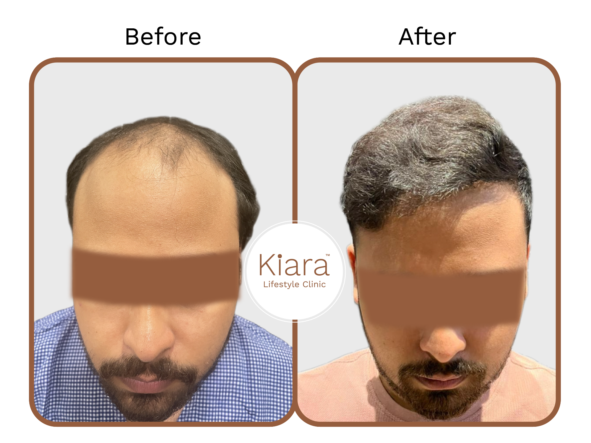 3rd Before & After Hair