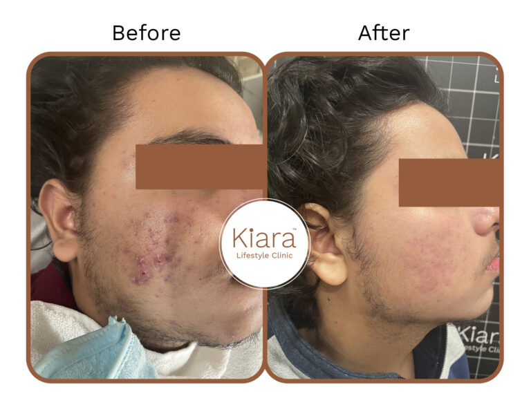 acne scar result