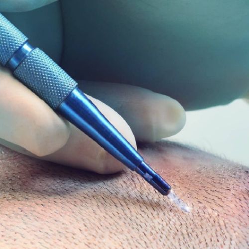 hair transplant in Delhi