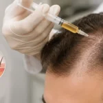 PRP Treatment for Hair Loss and Hair Thinning 