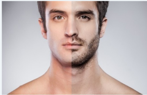 beard transplant in Delhi